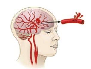 Hemorrhagic stroke