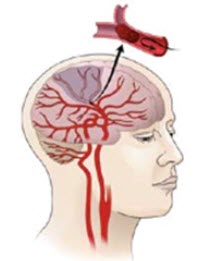 Ischemic stroke