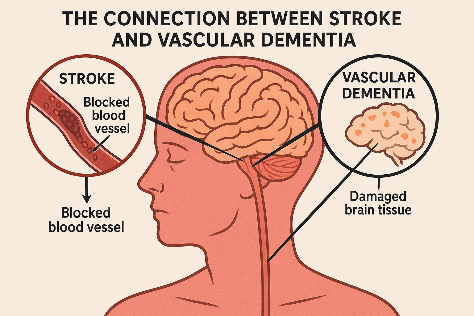 The connection between stroke and vascular dementia.